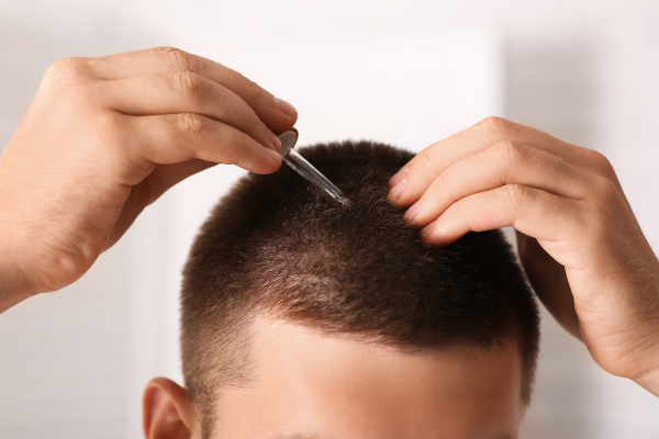 Effective Solutions for Receding Hairlines in Men