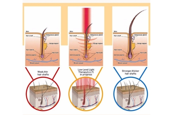 An infographic illustrates the effect of low-level light therapy (LLLT) on hair follicles, showing progression from weak, thin hair shafts to stronger, thicker ones. The center panel depicts LLLT in progress with a red light beam stimulating the follicle, flanked by “before” and “after” visuals of follicle structure and hair thickness.