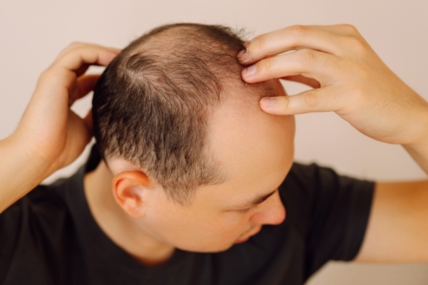 Man with visible hair thinning and bald spots examining his scalp by parting his hair with both hands, highlighting early-stage male pattern baldness.