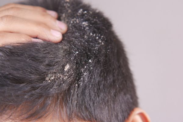 Close-up of a person’s scalp with visible dandruff and flaking as they part their short, dark hair with their hand. The image highlights a common scalp issue that Hair Mayraki addresses through its targeted scalp care treatments.