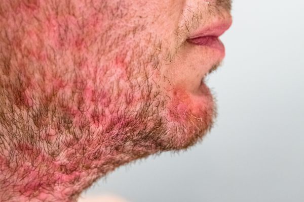 Close-up of a man’s lower face and neck showing red, irritated skin beneath patchy facial hair, likely caused by a pH imbalance or skin sensitivity in the beard area. The redness and inflammation suggest discomfort or a possible reaction to grooming products.