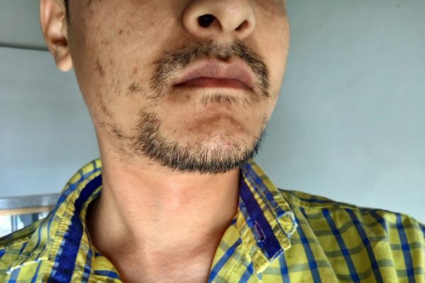 Close-up of a man's lower face with a patchy, uneven beard and sparse facial hair, wearing a yellow and blue plaid shirt, illustrating potential signs of beard thinning or stress-related hair loss.