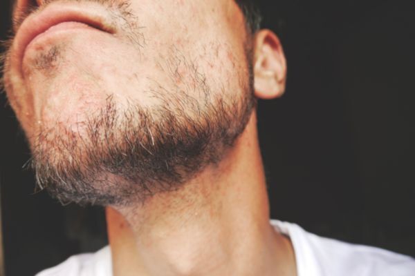Close-up of a man's patchy beard and jawline with uneven hair growth, highlighting natural facial hair texture and beard growth struggles.