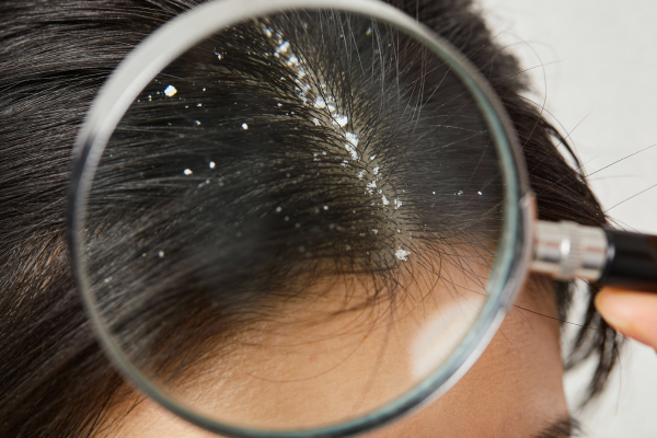 Summer Dandruff Symptoms Summer Dandruff Symptoms