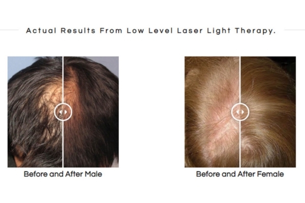 Side-by-side before and after photos show hair regrowth in a male and female after low-level laser light therapy. The male image shows significant darkening and thickening of hair on a previously thinning scalp, while the female image shows noticeable hair density improvement in a once sparse crown area.